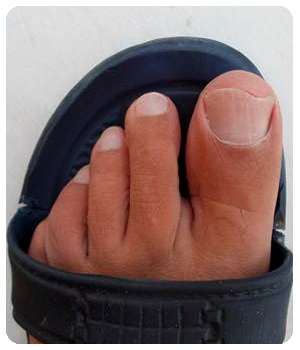 Благодаря препарату Feet protect ноготь восстановился.